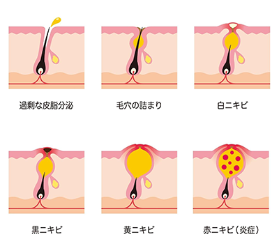 ニキビ跡が膨らむプロセス